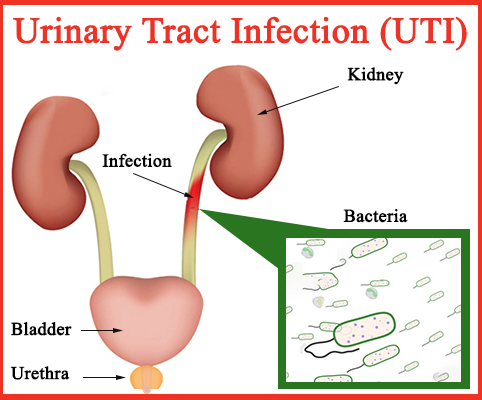 Urinary Tract Infection (UTI)