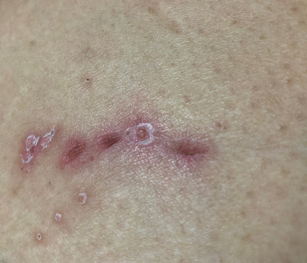What is a bedsore and how are they prevented?